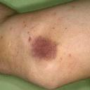 Тромбоцитопеническая пурпура - болезнь крови у деток